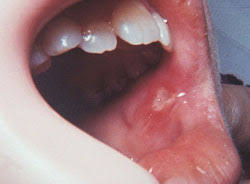 mouth sores and spots specialized