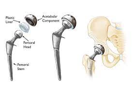 partial hip replacement surgery by dr