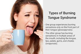 relieve burning tongue syndrome