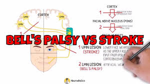 bell s palsy vs stroke nerve