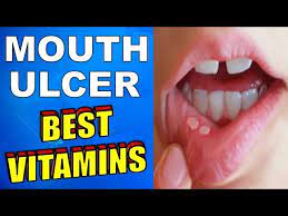 best vitamin for mouth ulcers