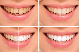 For example, veneers are usually not covered by insurance. Dental Bonding In Sioux Falls Sd Composite Teeth Bonding