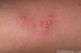Diaper rash with yeast infection signs: Mild Herpes The Symptoms Of Mild Genital Herpes Or By Ivan Kostenko Medium