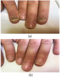 treatment of nail psoriasis