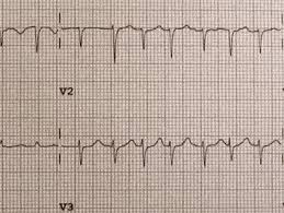 Several findings in this case point toward pericarditis. Pericardial Effusion Causes Symptoms And Treatment