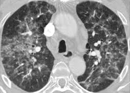 Αποτέλεσμα εικόνας για hypersensitivity pneumonia