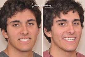 Deciding how to fix an underbite is a truly personal choice. Pin On Faceliftdentistry