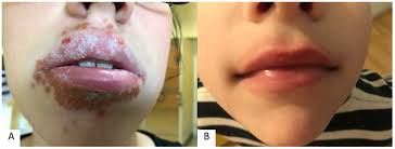 inflammation of the lips cheilitis