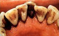 Jul 15, 2008 · you can drink less coffee for the same buzz—and save money. Tobacco Teeth Stains Cosmetic Dentistry