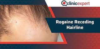 rogaine receding hairline clinicexpert