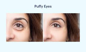 puffy eyes symptoms causes diagnosis