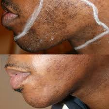 Laser hair removal penetrates the skin and destroys or damages individual hair follicles. Laser Hair Removal For People With Darker Skin Ethos Spa