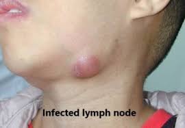 lymph node in children dr joann child