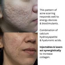 for acne scars
