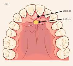 舌のトレーニング | アクア矯正歯科クリニック 矯正、綺麗な歯並び維持・改善, 舌のトレーニング