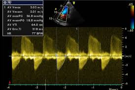 doppler echocardiography in aortic