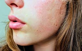 can exposure to mold cause a skin rash