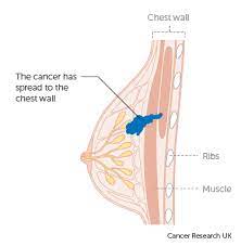 Phesgo also can be used in combination with taxotere (chemical name: Stage 3 Breast Cancer Cancer Research Uk
