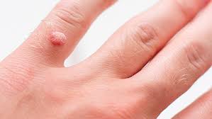 wart removal treatment wilmington
