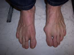 Image result for BUNIONS in shoes