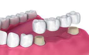 dental bridge keys dental specialists
