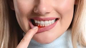 How long do braces hurt? Gum Swelling Treatment By Home Remedies And Professional Care Dentist In San Rafael Ca