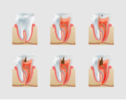 how do cavities form in your teeth