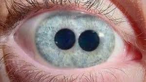 7 weird and rare eye conditions you