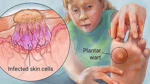 warts verruca vulgaris diagnosis and