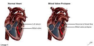 Mitral synonyms, mitral pronunciation, mitral translation, english dictionary definition of mitral. Mitral Valve Prolapse Cardiovascular Medbullets Step 2 3