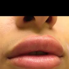 got juvederm filler in lips what are