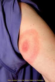 the dangers of lyme disease premier