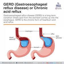 gerd or chronic acid reflux symptoms