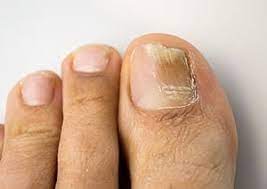 fungal nails foot and ankle clinic