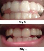 Gap teeth, or diastema, are spaces between the two front teeth. On My Way To A Hollywood Smile My Invisalign Journey