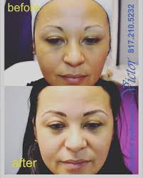 permanent makeup tattoo removal by