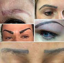 When undergoing laser tattoo removal, you're most likely to experience slight irritation and minor pain. Microblading Eyebrow Tattoo Removal Clean Slate Laser Tattoo Removal