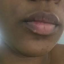 keloid scar on lip from tca photo