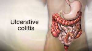 ulcerative colitis discharge