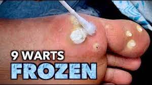 9 warts frozen on 1 foot with liquid