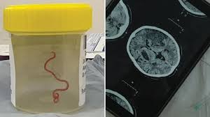 live parasitic worm found in woman s