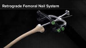 retrograde fem nail system surgical