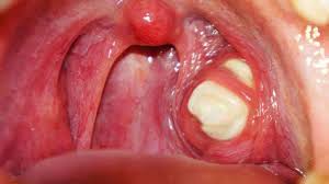 Image result for gale ke tonsil