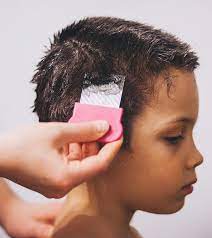 hair loss in children