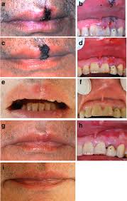 healing of open upper lip vermillion