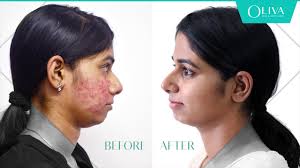cystic acne on face treatment