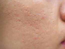 acne scars and dark spots