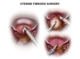 uterine fibroid removal surgery in