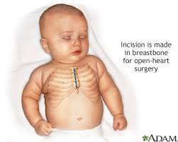 pediatric heart surgery information