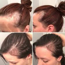 I've also included the before photo and a photo from 2 weeks after his. Testimonytuesday Postpartum Hairloss Is A Bummer Thinning In The Temple Area Losing H Postpartum Hair Loss Hair Loss After Baby Hairstyles For Thin Hair